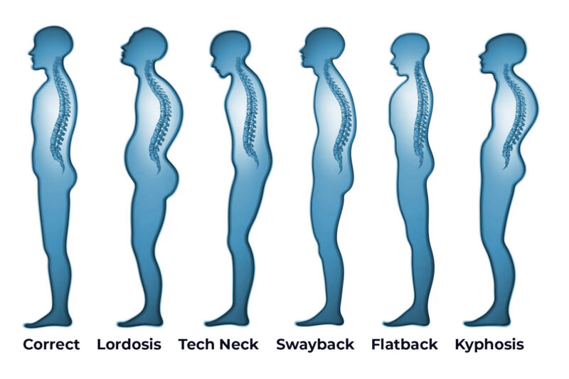 Illustration showing various types of bad posture and spinal problems, highlighting their effects on the body.