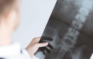 Doctor looking at a spinal x-ray.