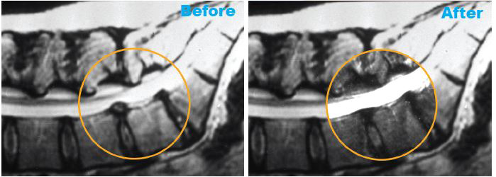 MRI images from a patient in the inversion group who experienced dramatic reduction of their herniated disc
